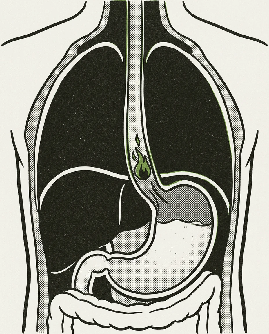 E-guide cover: Acid reflux